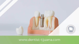 Read more about the article Myths about dental implants